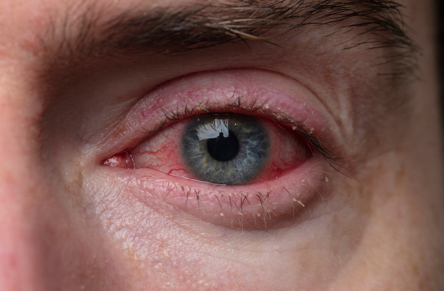 People Are Terrified of Getting Pink Eye from Farts