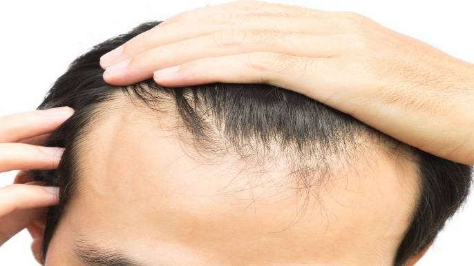 The Only Guide You’ll Ever Need to Fix Your Receding Hairline