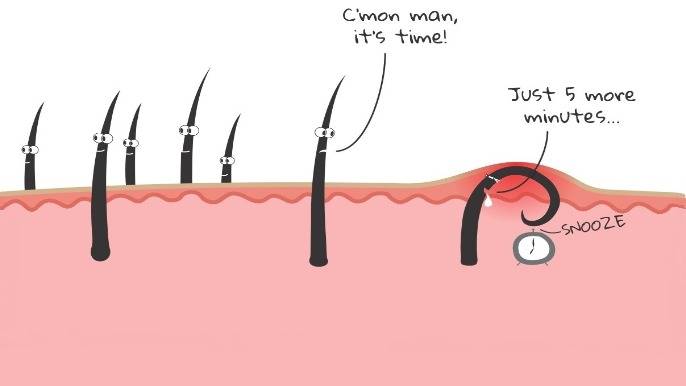 How to Deal with Ingrown Hairs